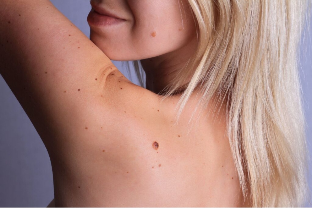 Çfarë është Melanoma, si të zbuloni shpejt dhe të parandaloni kancerin e lëkurës