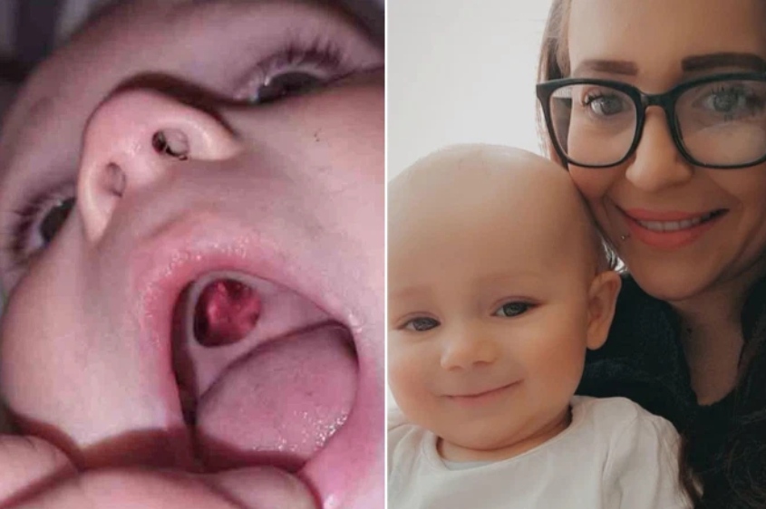Nëna alarmohet nga ‘vrima’ në gojën e bebes, por në repartin e emergjencës ishte tjetër histori (fotot)