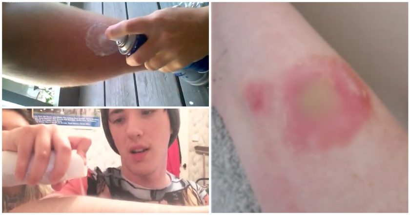 Prindër kujdes! Adoleshentët po dëmtojnë veten me sfidën e rrezikshme të deodorantëve në TikTok