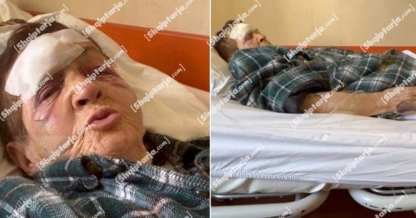 Nusja bën për spital vjehrrën në Shkodër! 82-vjeçarja: Më goditi me shkop, më mbuloi gjaku! Djali e mbajti të fshehtë dhunën në familje –Çkemi News
