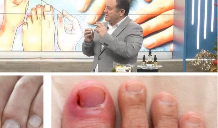 Ju futen thonjtë në mish? Ylli Merja tregon kurën natyrale që ju shpëton në pak ditë-Çkemi News